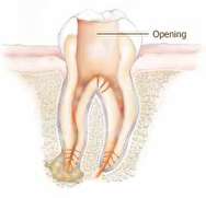 عصب کشی دندان و پرسش های رایج درباره آن