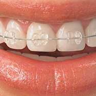 ارتودنسی یا کامپوزیت؛ برای دندان شما کدام بهتر است؟