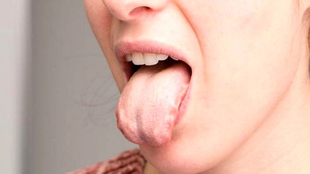 سوزش زبان نشانه این بیماری خطرناک است
