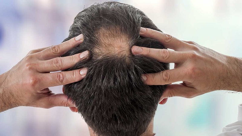 نوشیدن نوشابه‌های انرژی‌زا ریزش موی مردان را تشدید می‌کند