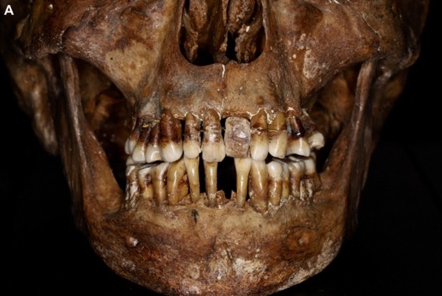 یک اشراف‌زاده قرن هفدهمی رازی مبتکرانه برای حفظ دندان‌هایش داشت(یک پزشک)