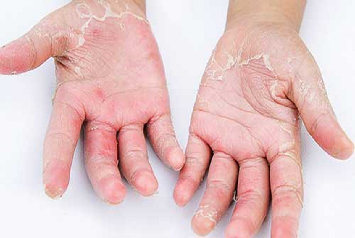 مراقب شایع‌ترین‌ بیماری‌های پوستی در نوروز باشید