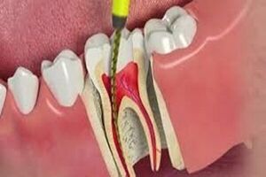 میزان دوام دندان ها بعد از عصب کشی