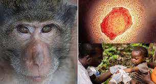 تفاوت و شباهت علائم آبله میمون و بیماری زونا