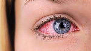 ۵ علت رایج قرمزی چشم و راه‌های درمان آن