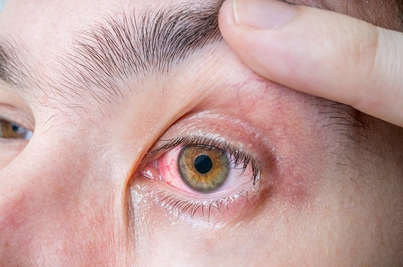 زمان مراجعه به پزشک به دلیل قرمزی چشم