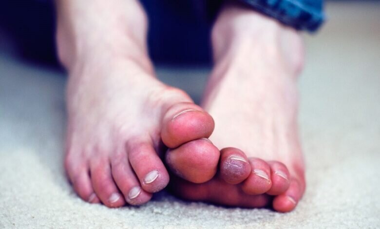 اگر پاهایتان در سرما متورم می‌شود بخوانید | این‌ علائم نشانه‌های پای مردابی است!