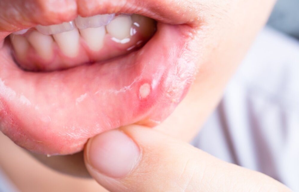 علت اصلی و نحوه درمان آفت‌های دهان