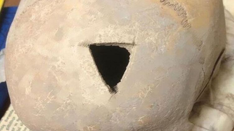 کشف جمجمه سوراخ شده انسان با قدمت ۳۲۰۰سال