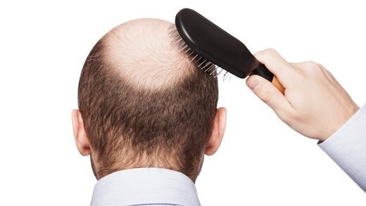 آیا این مکمل در جلوگیری از ریزش مو موثر است؟