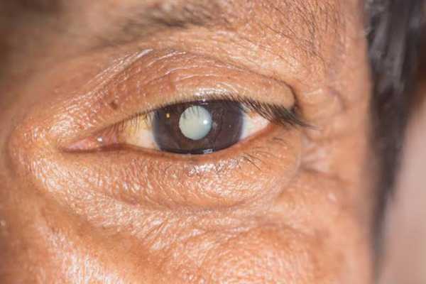 دلایل شایع تغییر نمره چشم چیست؟(روزیاتو)