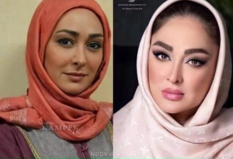 چهره الهام حمیدی قبل و بعد عمل زیبایی